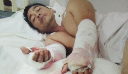  Anh Nguyễn Minh Cảnh phải phẫu thuật cả 2 tay.