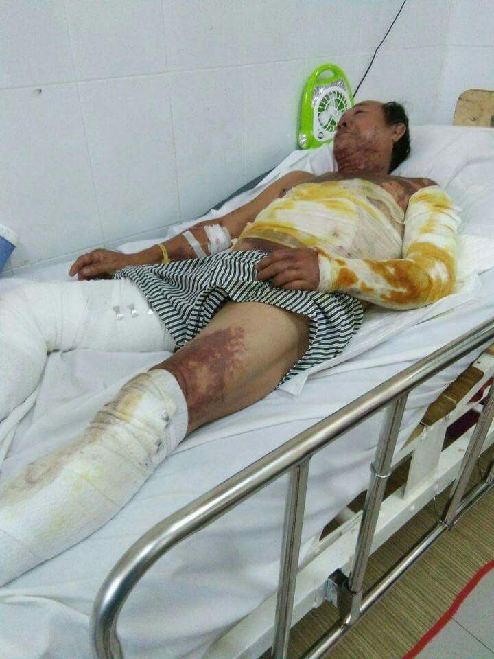 Ông Huỳnh Văn Tiến bỏng nặng toàn thân và tay trái bị phẫu thuật.