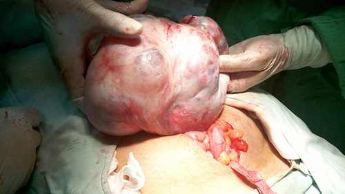 Khối u nang buồng trứng nặng 6,1kg được lấy ra từ ổ bụng bệnh nhân N.T.T