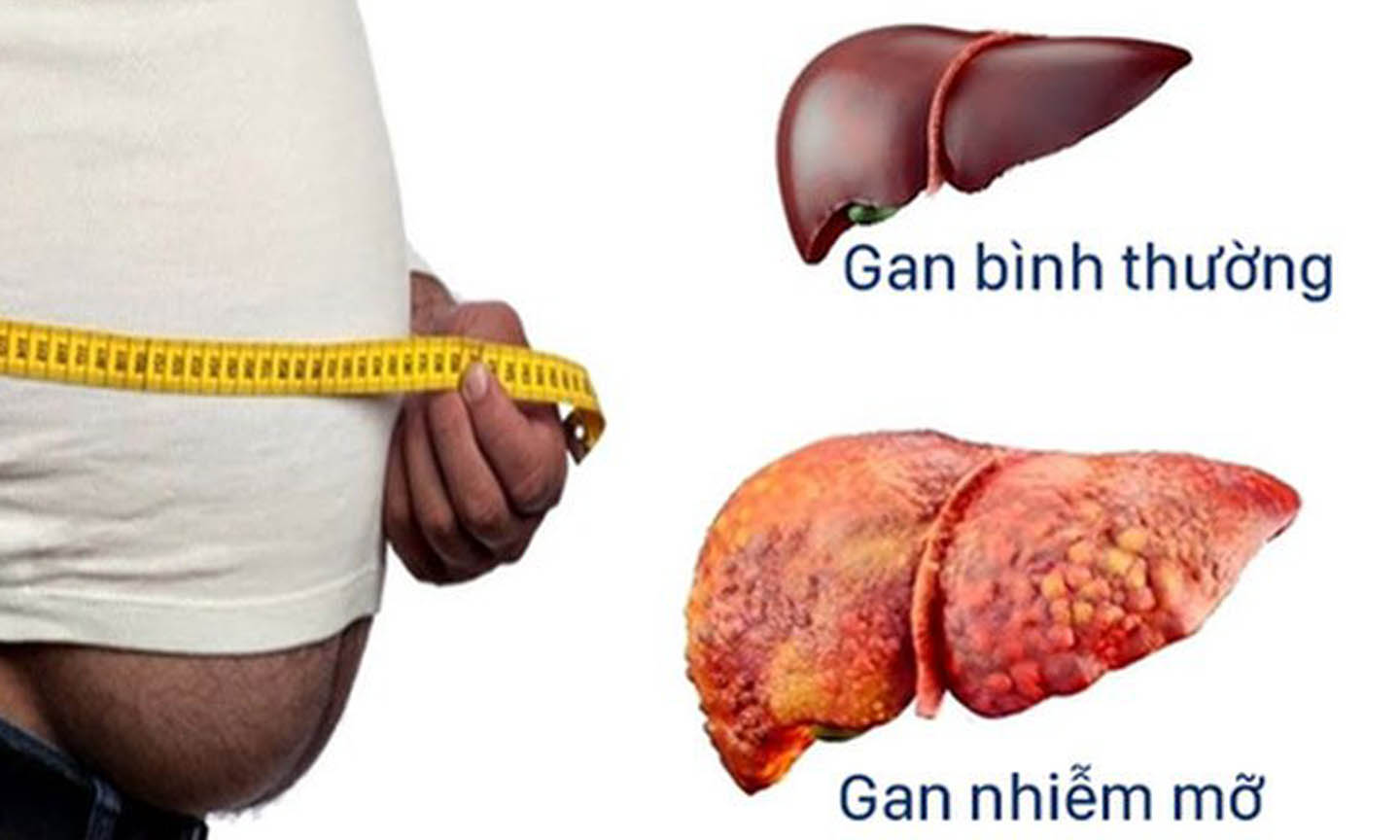 Gan nhiễm mỡ là tình trạng gan có chất béo tích tụ ở bên trong vượt quá 5% trọng lượng của gan.