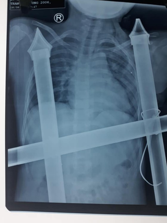 Hình ảnh chụp X-quang về tình trạng của cháu D. 