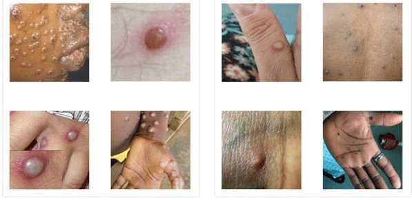 Các tổn thương trên da với bệnh nhân đậu mùa khỉ.