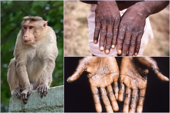 Bộ Y tế yêu cầu các địa phương, đơn vị giám sát chặt chẽ dịch bệnh đậu mùa khỉ.