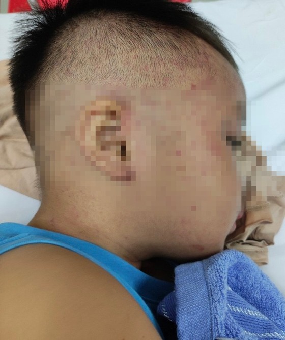 Bé trai ở xã Nhân Chính, Lý Nhân, Hà Nam bị bạo hành với nhiều vết thương ở vùng đầu, mặt và cổ. (Nguồn: sggp.org.vn)