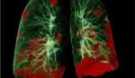 Thử nghiệm thuốc mới chữa viêm phổi cho kết quả khả quan