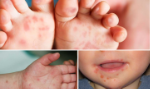 Đã xác định kiểu gene của Enterovirus 71 gây bệnh tay chân miệng nặng ở trẻ em