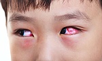 Đau mắt đỏ do enterovirus, chăm sóc và phòng bệnh thế nào?