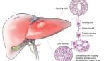 Lần đầu tiên nút động mạch gan điều trị ung thư