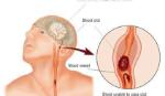 Nhật Bản tạo công thức tính toán nguy cơ đột quỵ