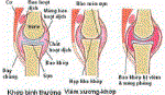 Kỹ thuật mới điều trị bệnh thấp khớp