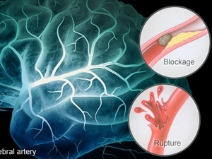 Ảnh minh họa. (Nguồn: thestrokethrivers)