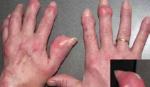 Bị bệnh gout nên ứng phó thế nào?