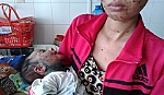 Mẹ đã cách ly, sao con vẫn bị thủy đậu?