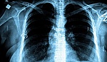 Bệnh lao nguy hiểm ngang HIV