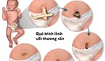 Lưu ý khi chăm sóc rốn ở trẻ sơ sinh