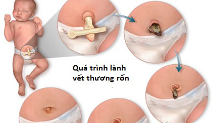 Cần vệ sinh rốn cho trẻ thật sạch để quá trình lành vết thương rốn sẽ nhanh hơn.
