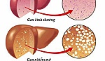 Cảnh giác dấu hiệu bệnh gan nhiễm mỡ