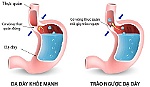 Cách ngăn chặn tình trạng trào ngược axit dạ dày