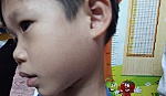 Đã chích ngừa quai bị vẫn mắc bệnh, vì sao ?