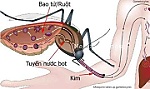 Dấu hiệu chuyển nặng của bệnh sốt xuất huyết và Covid-19 khác nhau thế nào?