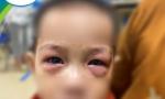 Đau mắt đỏ có xu hướng gia tăng, Bộ Y tế khuyến cáo 5 biện pháp phòng chống