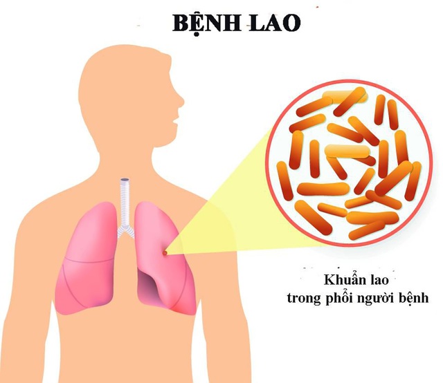 Tăng cường công tác phòng, chống bệnh Lao.