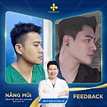 Nâng mũi L line hay S line bền đẹp, an toàn hơn?