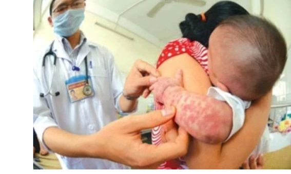 Số trẻ nhỏ bị sởi đang gia tăng, các gia đình cần chủ động đưa trẻ đi tiêm vaccine phòng sởi.