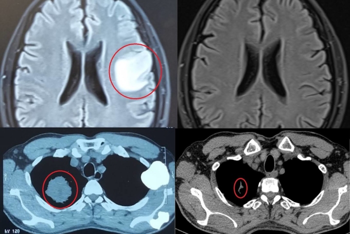 Kết quả chụp cộng hưởng từ não (trên) và chụp cắt lớp vi tính phổi (dưới) của ông Duy trước và sau điều trị. Ảnh: Bệnh viện Đa khoa Tâm Anh